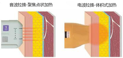 电波拉提,电波拉提原理,电波拉提作用