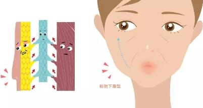 电波拉提,电波拉提原理,电波拉提作用