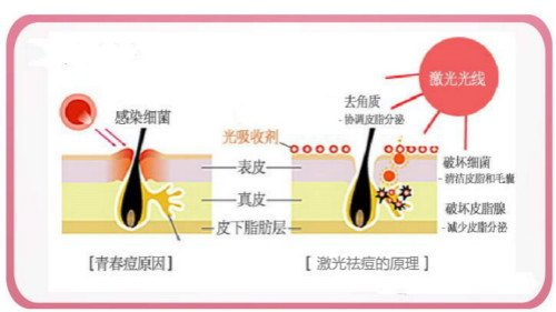 激光祛痘术后护理,激光祛痘时间,激光祛痘效果,激光祛痘仪器