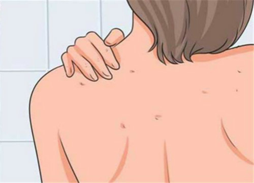 背上的痘痘怎么消？10个方法让你的背开启美肌模式