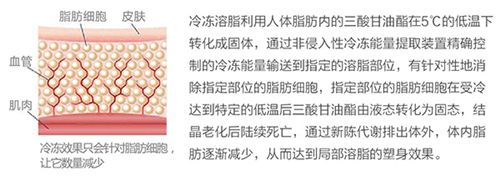 冷冻溶脂减肥仪有效吗? 冷冻溶脂减肥仪有效吗?