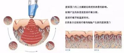 减肥/抗衰两不误，BTL溶脂刀仪器一次满足你