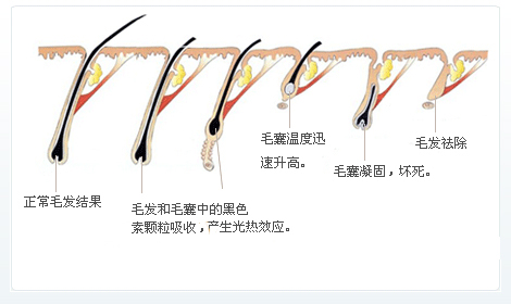 脱毛为什么一次性脱不干净？原因在这里