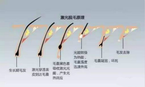 激光脱毛原理