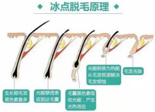 冰点脱毛原理