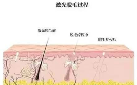 激光脱毛过程