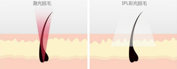 激光脱毛仪和IPL彩光脱毛仪的区别