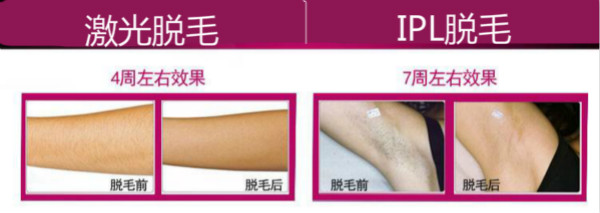 激光脱毛 VS 彩光脱毛 激光脱毛 VS 彩光脱毛