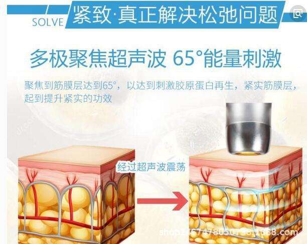 雷达精雕仪丨不只是脸，这一次要让自己的身体更年轻！