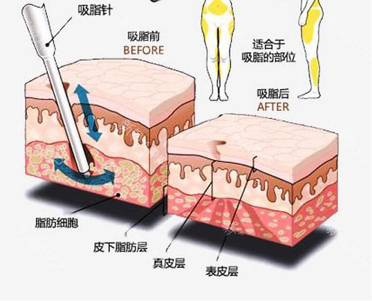 用核磁仪器爆脂减肥？只是一个噱头而已