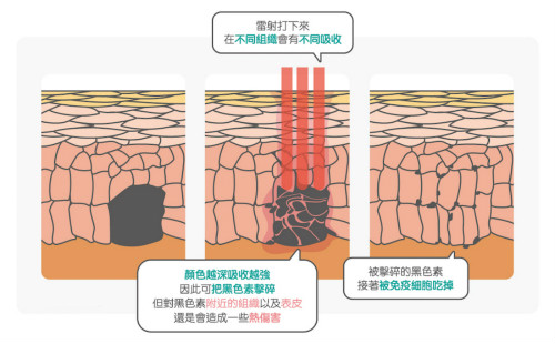 激光仪器美白淡斑：净肤激光、粉饼激光、光纤激光比较及注意事项