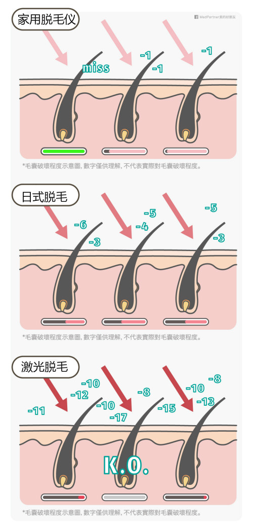 日式脱毛、家用脱毛仪及激光脱毛的功效价格大评比