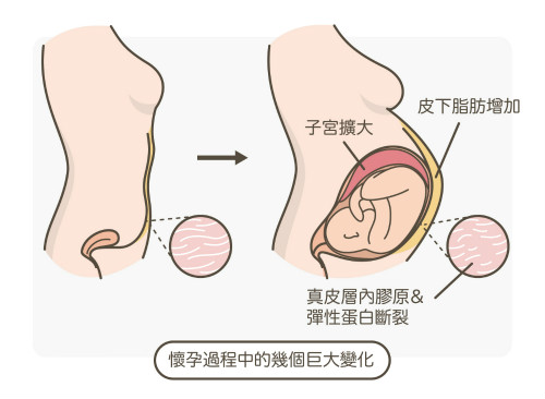 一文秒懂！妊娠纹肥胖纹保养、治疗及预防全攻略