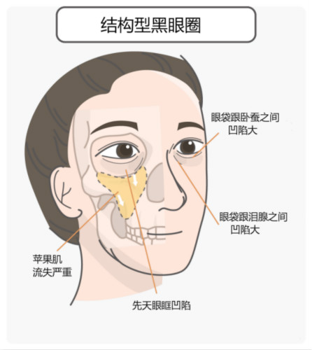 区分黑眼圈！黑眼圈的成因、分类、预防与治疗全攻略