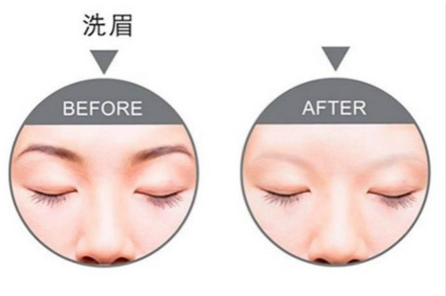 激光洗眉机怎么用?飘眉或雾眉失败如何处理? 激光洗眉机怎么用?飘眉或雾眉失败如何处理?