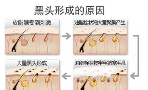 美容仪器厂家教您如何快速祛除黑头？