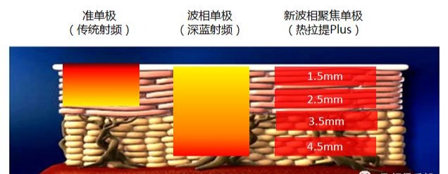 射频医美抗衰发展史！射频美容仪到底哪里好？