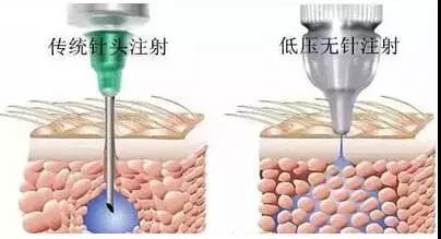 无创水光仪的出现可否取代水光针的治疗呢