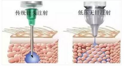 无创水光美容仪可以替代水光针治疗吗？